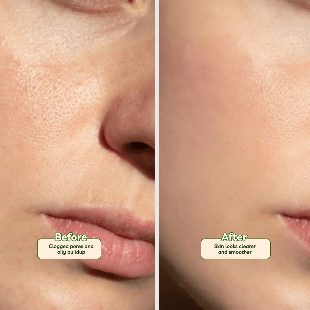 Nano White Soap Pack of 3 | Salicylic, Glycolic Acid & Green Tea