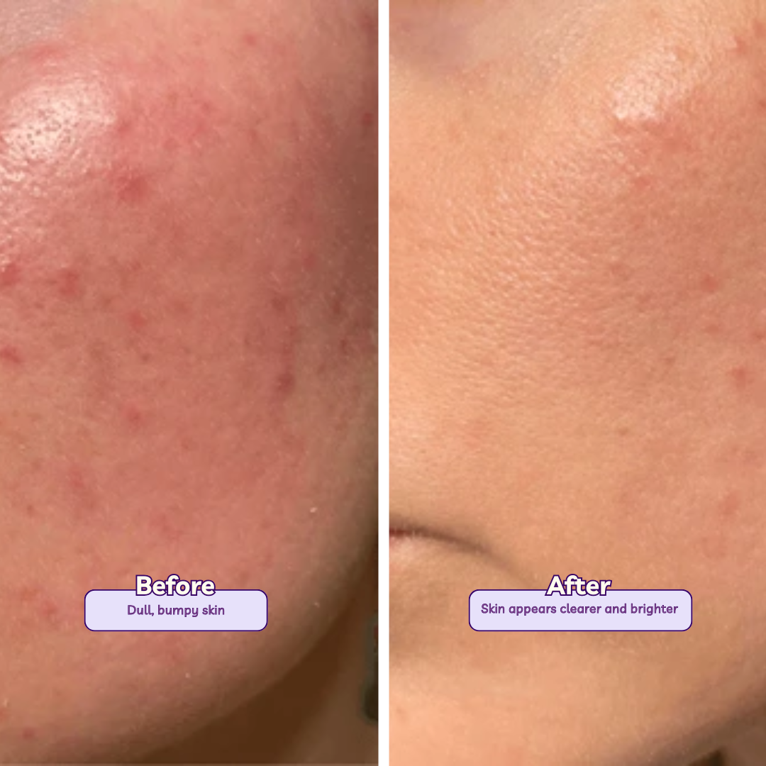 Nano White 1% Kojic Acid, 1 % Niacinamide & Alpha Arbutin |Acne Pimple|Dark Spot|Lightening Brightening Pigmentation Foaming Face wash 100 ml